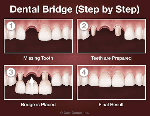 bridges